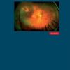 Vitreoretinální chirurgie - Image 2