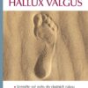Hallux valgus - Image 2